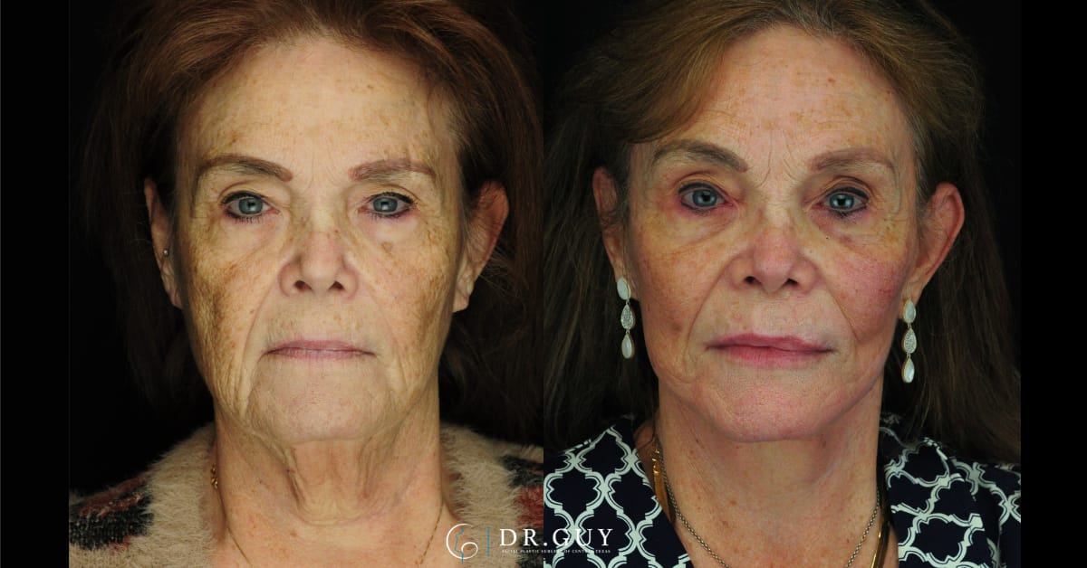 Why The CO2 Laser Is So Effective For Anti-Aging - Associates in Plastic  Surgery