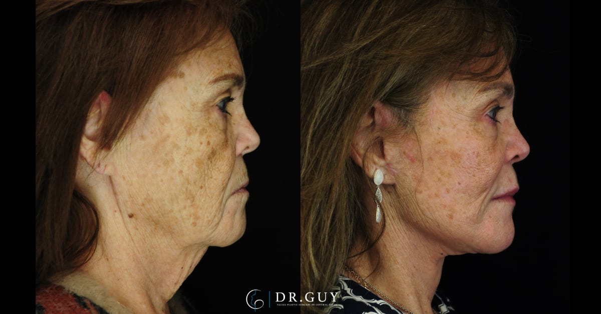 Advanced Laser Skin Resurfacing in Central TX – Facial Plastic