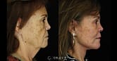 Advanced Laser Skin Resurfacing in Central TX – Facial Plastic Surgery of  Central Texas