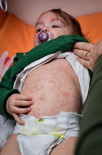 Infant with red rash from measles 