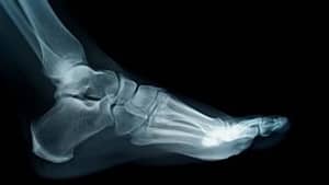 Foot fractures