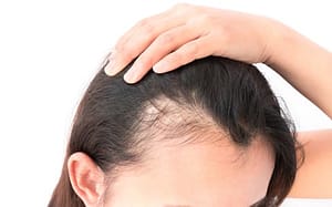 Platelet Rich Plasma (PRP) for Thinning Hair