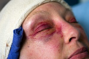 Woman with bandaged head and bruising around her eyes