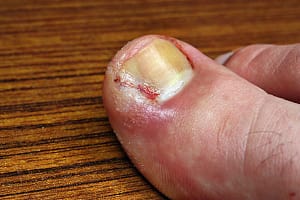Ingrown - toe bleeding