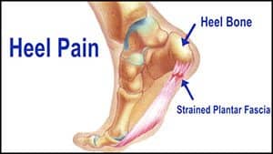 Traumeel injections for hot sale plantar fasciitis