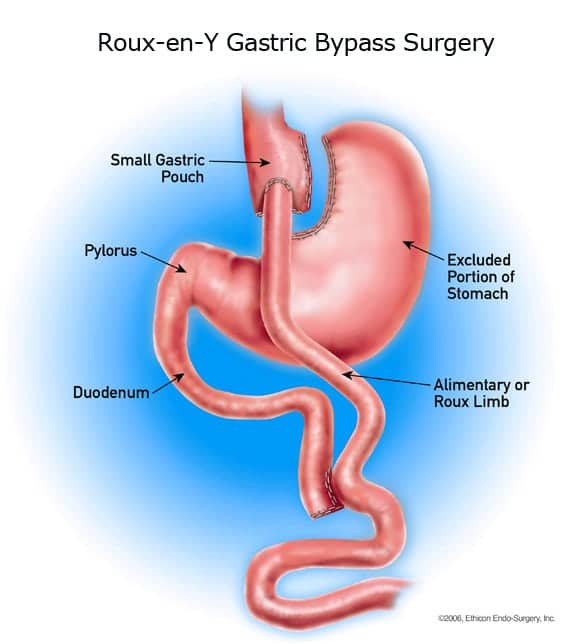roux en y gastric bypass anatomy