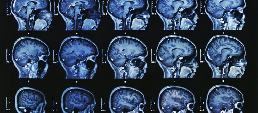 Deep brain stimulation is an advanced treatment for Parkinsons disease