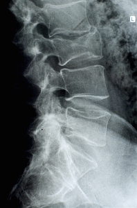 A aertebral fracture close up