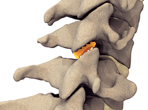 Implants are used to lift and separate the bones of the spine (vertebrae). This can create significantly more area for the nerve root.1 The implants also stabilize the joint to help the bones to heal and fuse together.