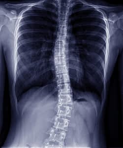 X-ray of spine with scoliosis