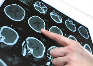 New technology is improving the safety and effectiveness of brain tumor surgery
