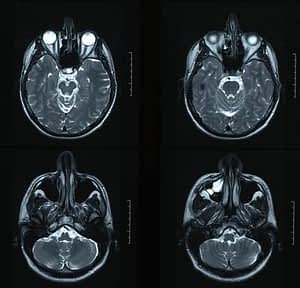 X-rays of brain
