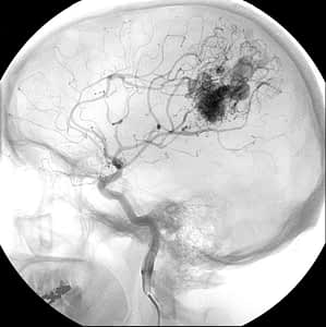 Arteriovenous malformation (AVM) in the brain