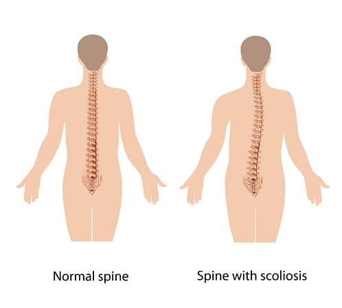 The difference between a normal spine and a spine affected by the condition known as scoliosis.