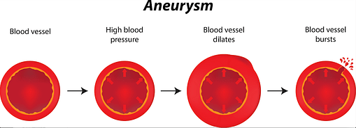A detailed diagram of an aneursym.