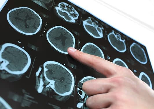 CT scan of brain revealing stroke details.