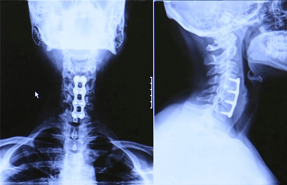 An x-ray image of a cervical-herniated-disc