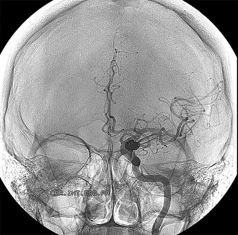 Scan of an aneurysm in the brain.