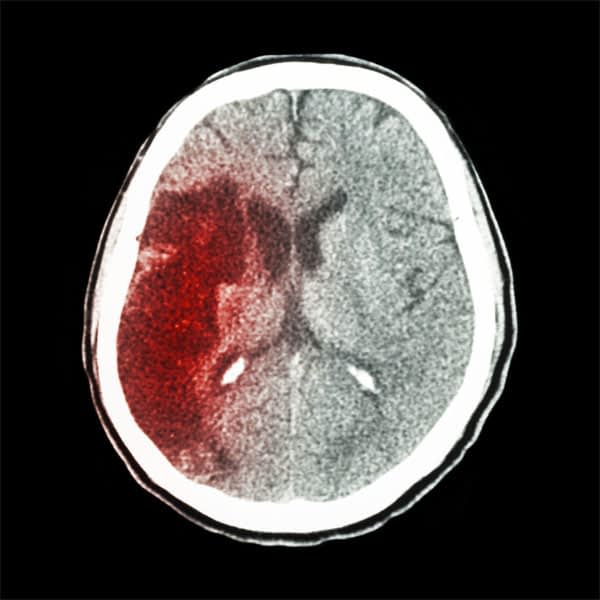 Brain scans are one way to access the risk of a stroke.